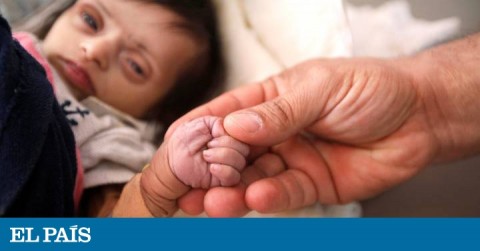Nurse holding hands with a malnourished 2 months old baby two days before she died