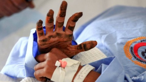 A Yemeni girl receives treatment at a hospital in the capital Sanaa for wounds sustained during an air strike in northern Hajjah province.